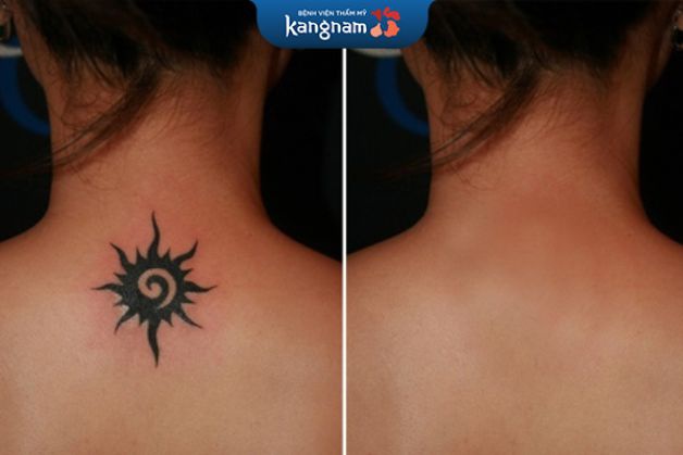 Xóa xăm không để lại sẹo và không làm ảnh hưởng đến sắc tố da