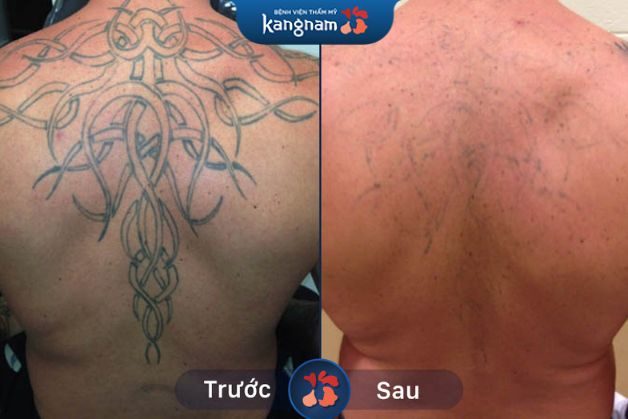 Hình xăm kích thước lớn mờ đến 95%