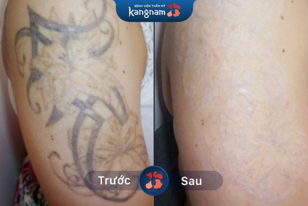 Xóa sách mọi dấu vết của hình xăm cũ