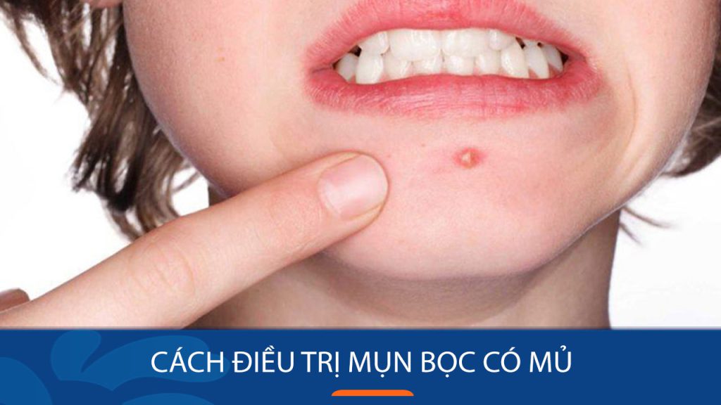 Cách Trị Mụn Bọc Có Mủ: 9 Bí Quyết Hiệu Quả Từ Chuyên Gia Da Liễu