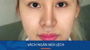 Vách ngăn mũi lệch