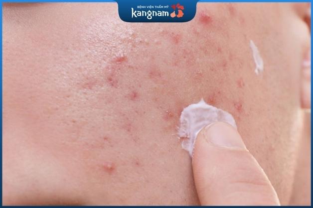 Dùng thuốc Tây trị mụn tương đối nhanh nhưng cần được bác sĩ hướng dẫn