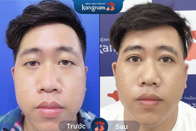 Mí mắt không còn sưng đau, bầm tím