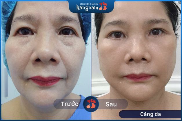 Căng da an toàn, không lộ dấu vết thẩm mỹ