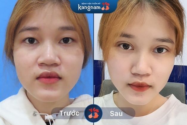 Mí đều và tự nhiên như chưa phẫu thuật