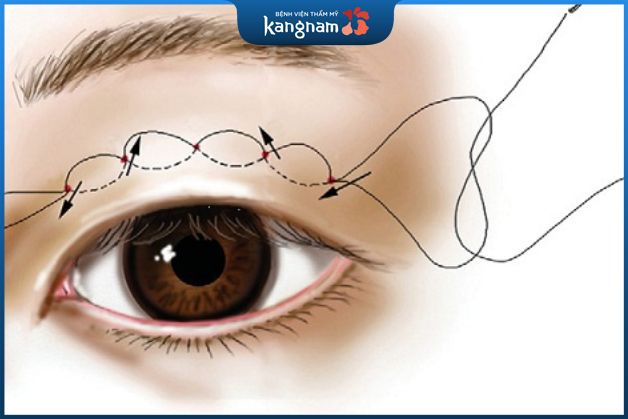 Cắt mí rồi có nhấn mí được không