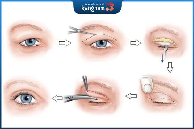 Cắt mí rồi có nhấn mí được không
