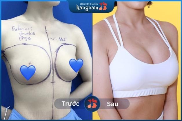 Treo ngực sa trễ ở đâu uy tín