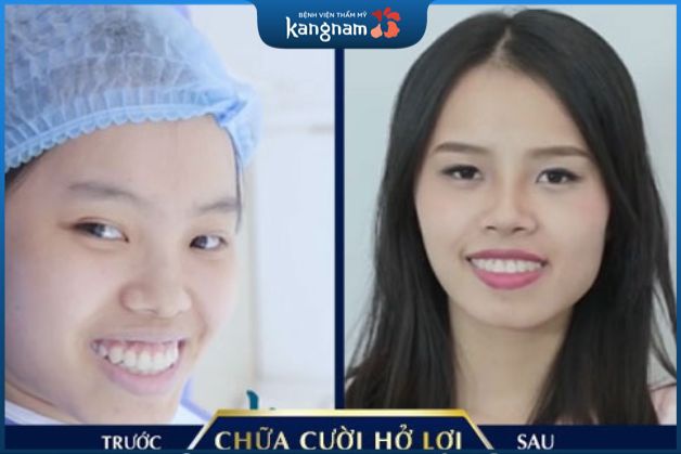 Điều trị cười hở lợi toàn diện cho khách hàng