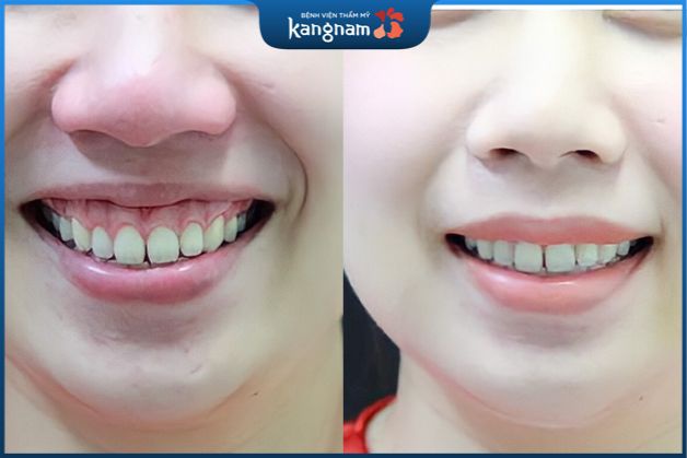 Nụ cười tươi tắn và rạng rỡ hơn sau khi phẫu thuật cắt lợi