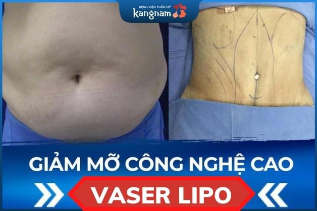 Công nghệ hút mỡ Vaser Lipo giảm mỡ đến 90%