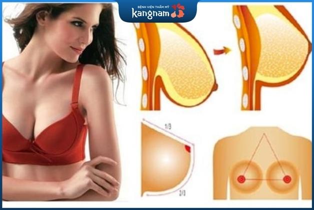 Công nghệ treo ngực sa trễ hiện đại, ít xâm lấn