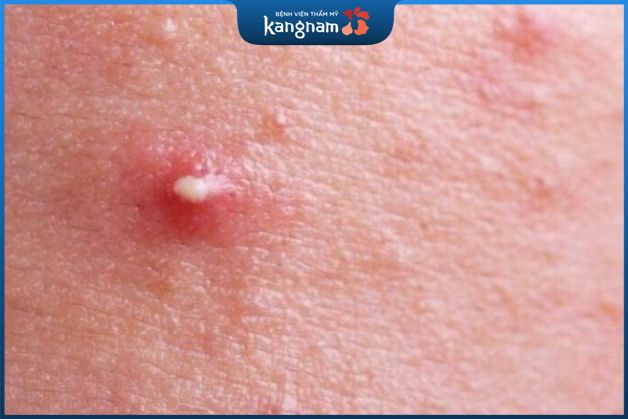 Dấu hiệu nhận biết mụn nhọt ở mặt