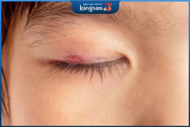 Đến tháng có cắt mí được không