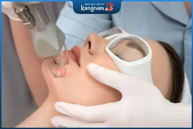 Điều trị mụn ẩn bằng Laser Co2