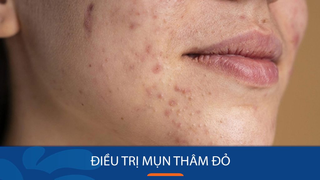 14 Bí quyết đánh bay mụn thâm đỏ, trả lại làn da trắng sáng