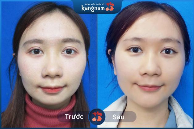 Khách hàng trẻ trung hơn sau khi độn cằm