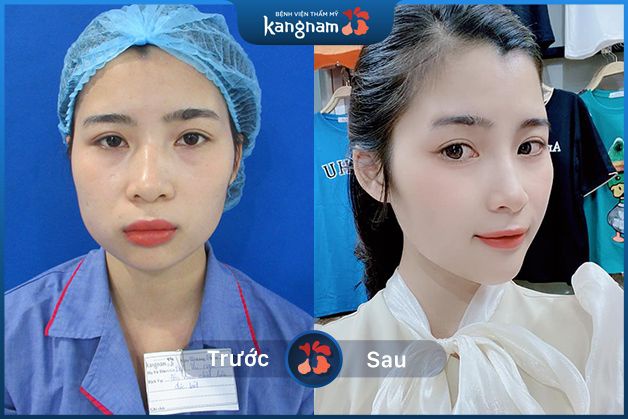 Cằm V-line cân đối với gương mặt