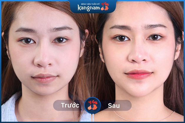 Độn cằm tự nhiên không lộ sẹo