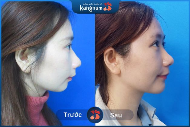 Góc nghiêng 'thần thánh' nhờ độn cằm Kangnam