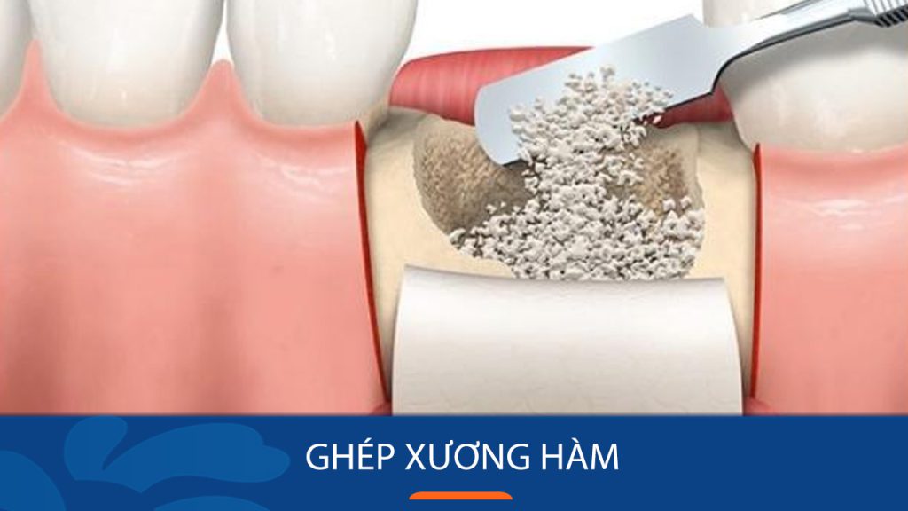 Ghép xương hàm là gì? Khi nào cần, phương pháp và chăm sóc sau ghép