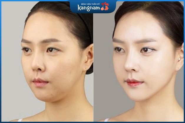 Căng da chỉ vàng có tốt không?