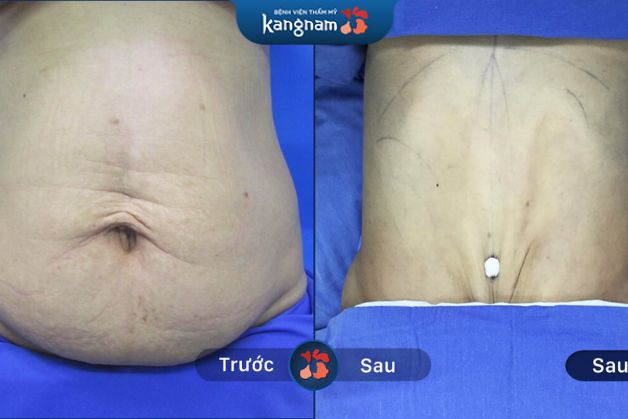 Mỡ bụng lâu năm được loại bỏ tối đa