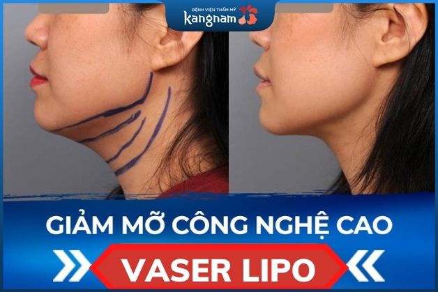 Hút mỡ cằm Vaser Lipo