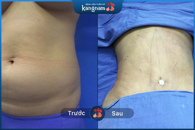 Hút mỡ Vaser Lipo ở vùng bụng