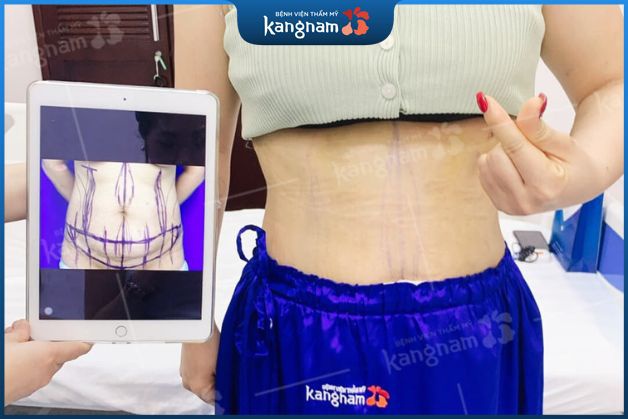 Hút mỡ bụng toàn diện, da bụng phẳng, không có da thừa