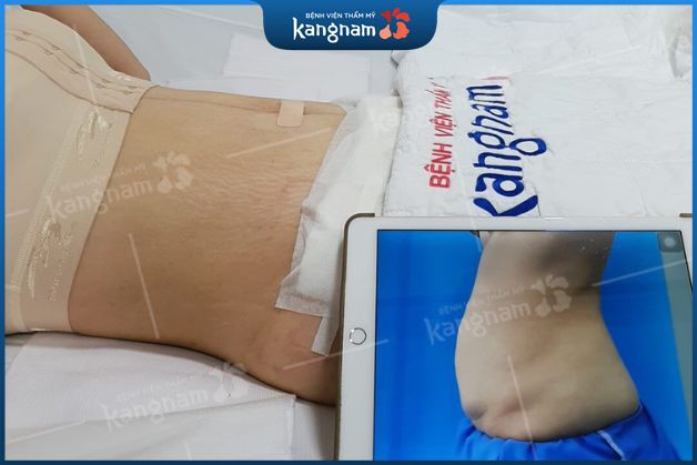 Hút mỡ bụng hiệu quả, hồi phục nhanh chóng