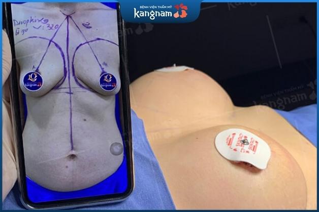 Treo ngực sa trễ có cho con bú được không