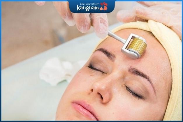 Lăn kim trị sẹo rỗ nhanh chóng sau vài buổi