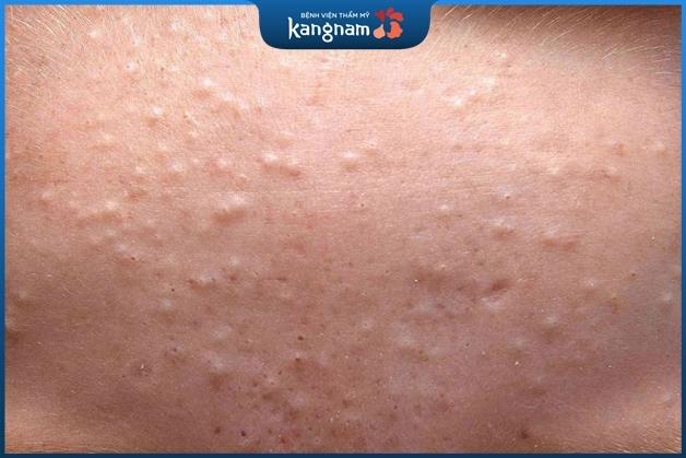 Mụn ẩn tồn tại lâu ngày khiến làn da sần sùi