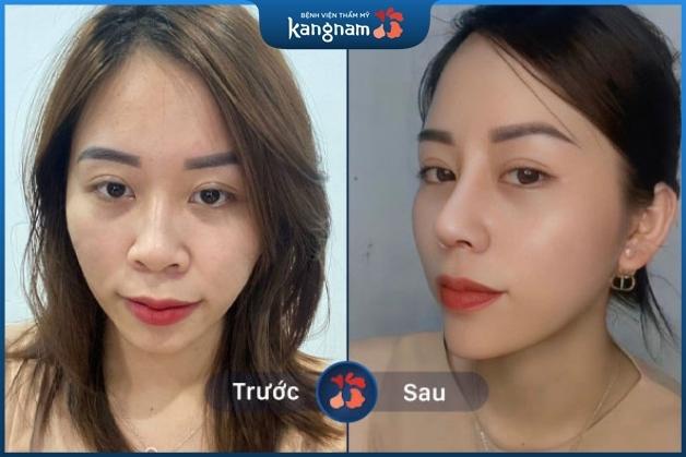 Nâng mũi 1 tháng đã ổn định chưa?