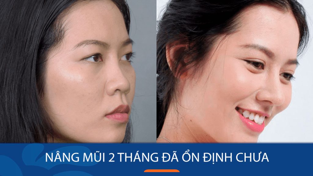 Nâng mũi 2 tháng đã ổn định chưa? 2 Cách chăm sóc sau nâng mũi