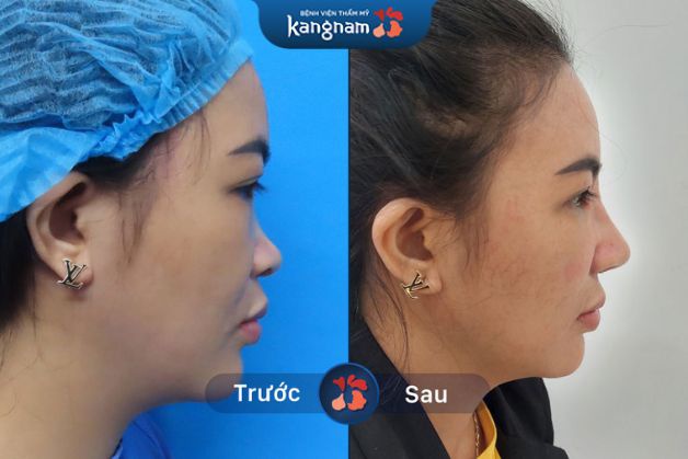 Nâng mũi phục hồi nhanh chóng sau 1 tuần