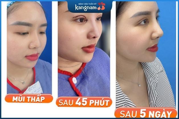 Nâng mũi 6D Kangnam hồi phục siêu nhanh, mũi đẹp tự nhiên