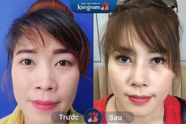 Không gây đau đớn và lộ vết tích thẩm mỹ