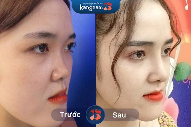 Mũi cao tây tự nhiên, không lộ dấu tích thẩm mỹ