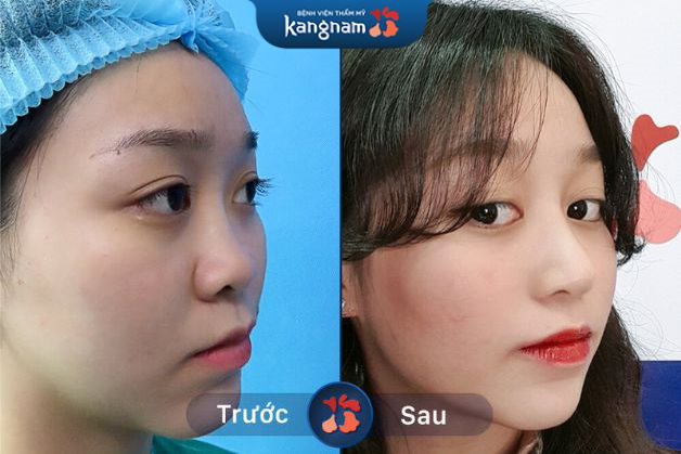 Nâng mũi phải nghỉ dưỡng bao lâu