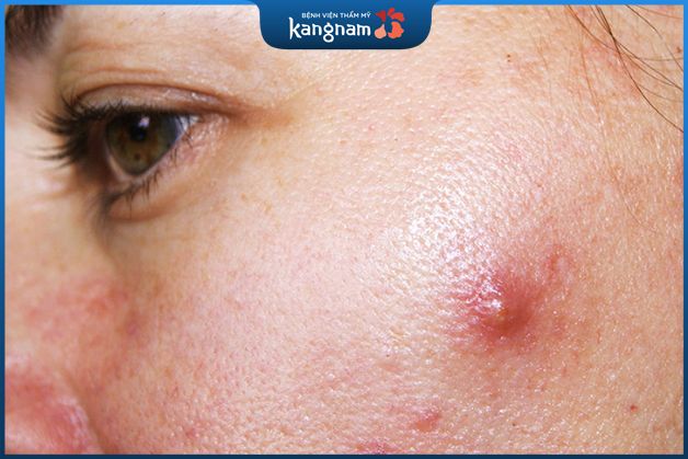 Nguyên nhân gây nên mụn nhọt ở mặt