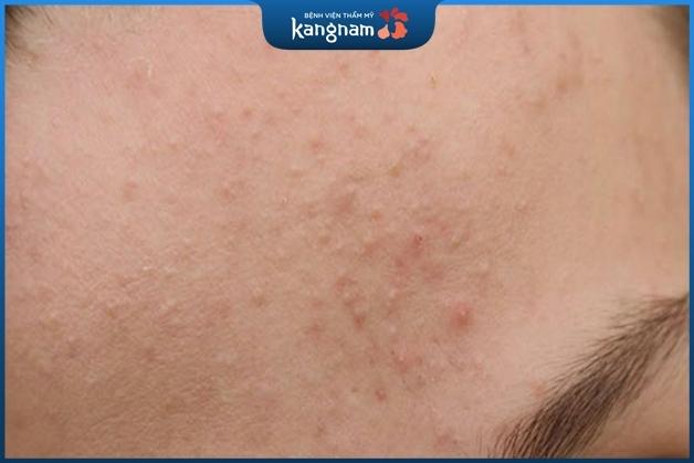 Có nhiều nguyên nhân làm hình thành mảng mụn ẩn