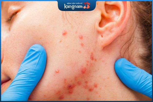 Nguyên nhân gây ra mụn thâm đỏ