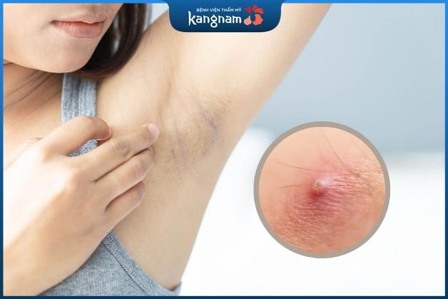 Nhận biết mụn nhọt ở nách sớm giúp bạn điều trị kịp thời