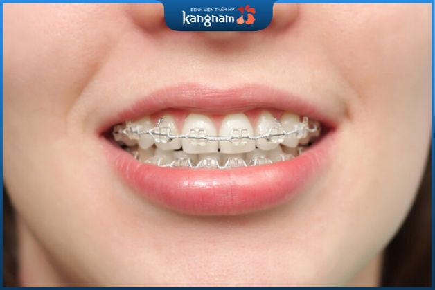 Phương pháp niềng răng chỉnh nha