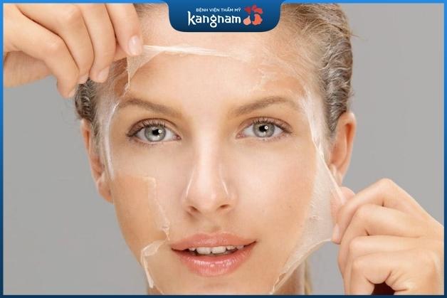 Peel da chữa mụn và làm đẹp hiệu quả