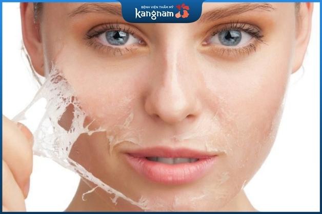 Peeling giúp thay đổi bề mặt da mới