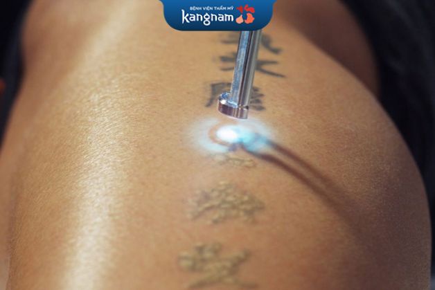 Xóa hình xăm mất bao lâu