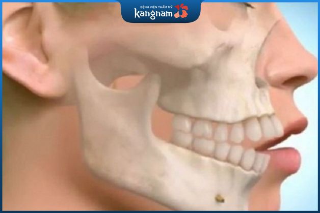 Phẫu thuật chỉnh răng hô hàm trên